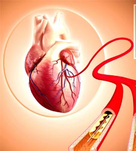 coronary-angioplasty